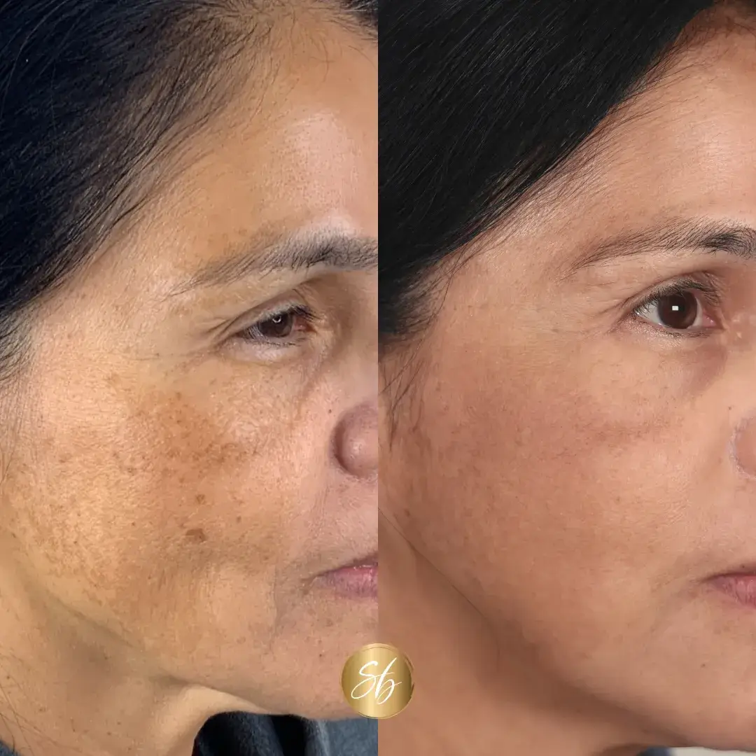 sun damage skin treatment | before and after photo | Soul And Beauty Med X | Mission Viejo, CA