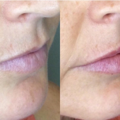 Lip fillers | Soul and Beauty MEDx | Mission Viejo, CA