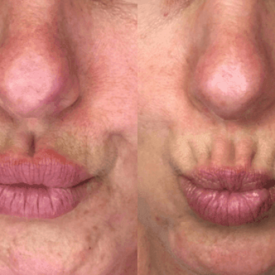 Lip fillers | Soul and Beauty MEDx | Mission Viejo, CA