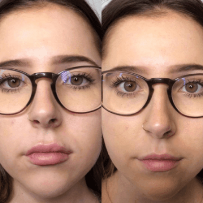 Lip fillers | Soul and Beauty MEDx | Mission Viejo, CA