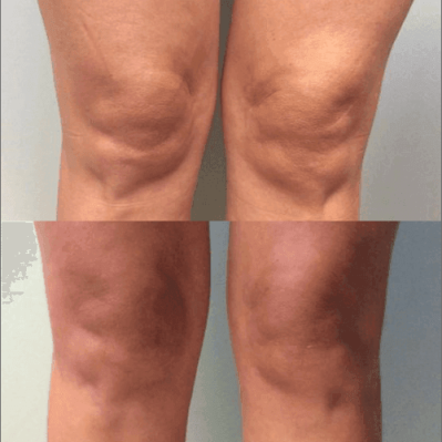 Body treatment Before and after Treatment result in Mission Viejo, CA | Soul And Beauty Med X