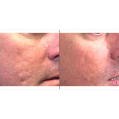 Skin treatment Before and after Treatment result in Mission Viejo, CA | Soul And Beauty Med X