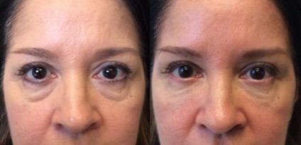 Dermal Fillers Before and after Treatment result in Mission Viejo, CA | Soul And Beauty Med X