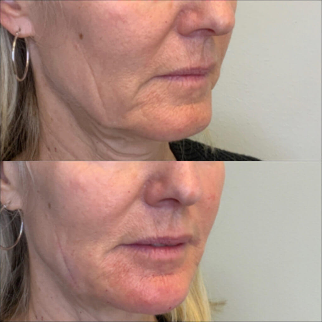 Lower Face Fillers Before and After Treatment Photos in Mission Viejo, CA | Soul and Beauty MEDx