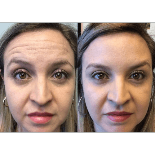 Injectables Before and after Treatment result in Mission Viejo, CA | Soul And Beauty Med X