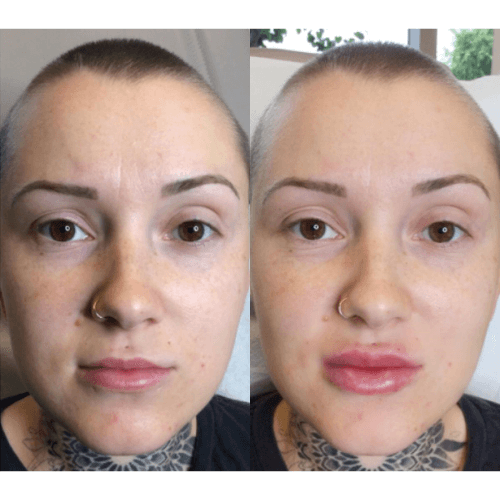 Facial Before and after Treatment result in Mission Viejo, CA | Soul And Beauty Med X