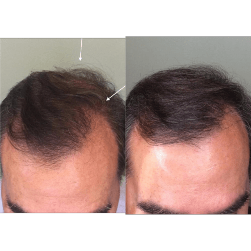 Hair restoration Before and after Treatment result in Mission Viejo, CA | Soul And Beauty Med X