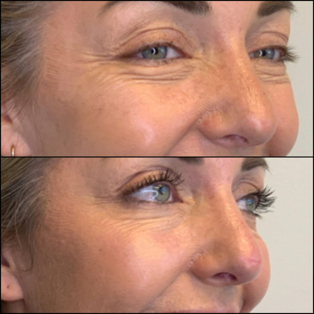 Botox Before & after Treatment result in Mission Viejo, CA | Soul And Beauty Med X