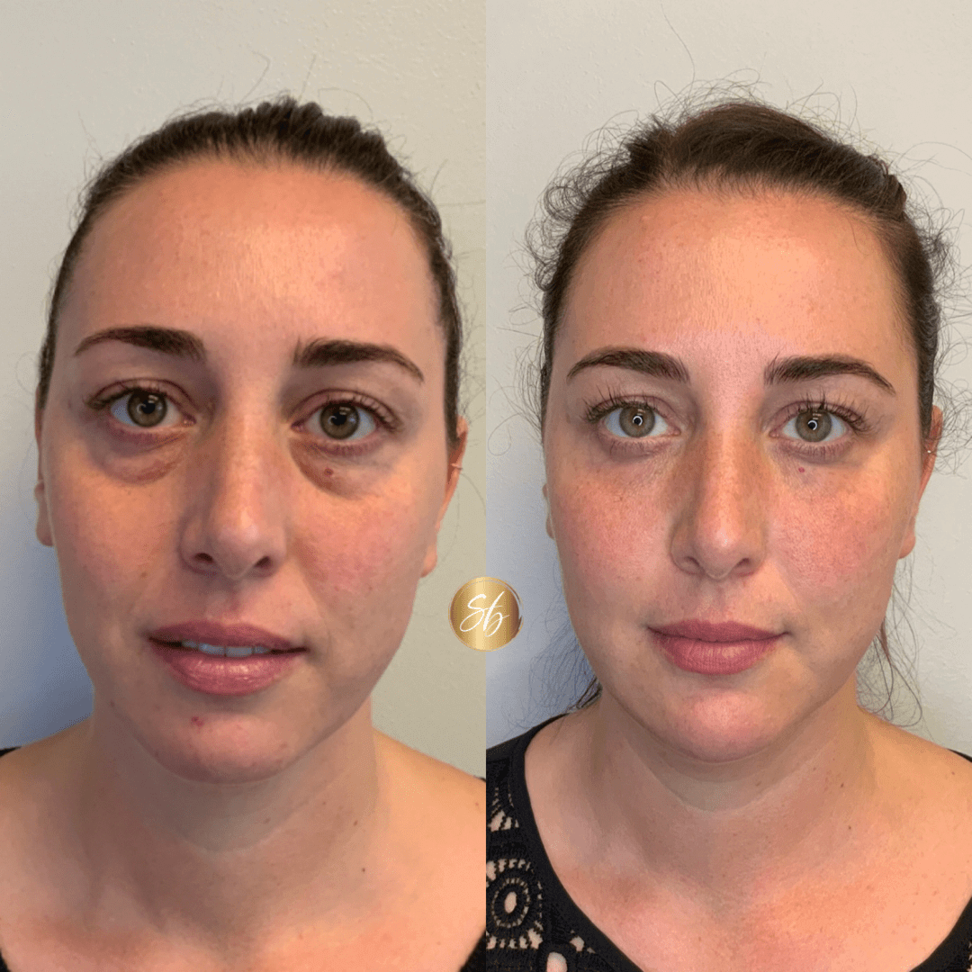 Facial Fillers Before And After Images Soul And Beauty Medx