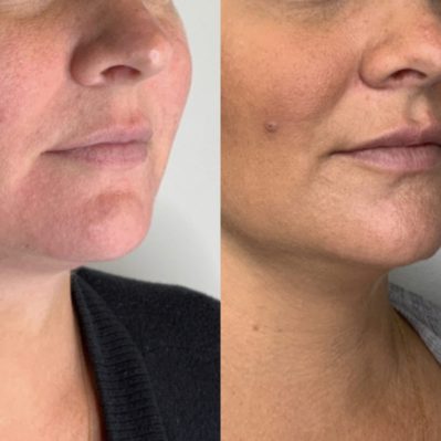 Lower Face Filler | before and after image | Soul and Beauty MEDx | Mission Viejo, CA