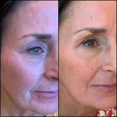 Botox Before & after Treatment result in Mission Viejo, CA | Soul And Beauty Med X